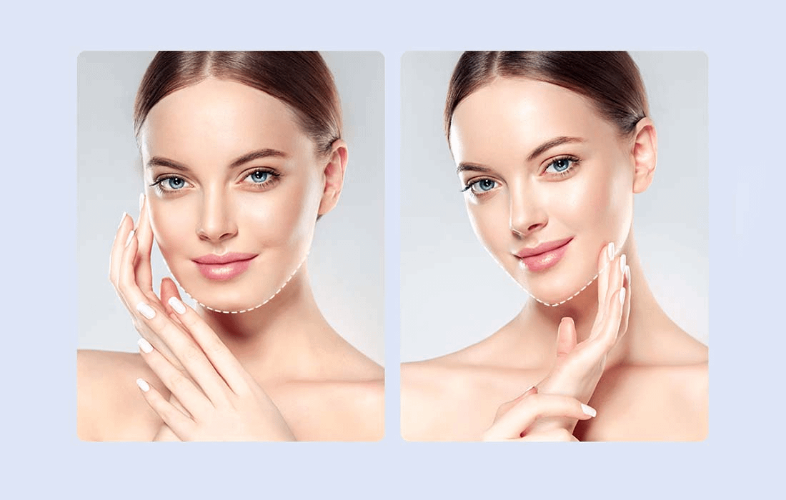 ANLAN ALVLY01-03 kais za podizanje linije brade