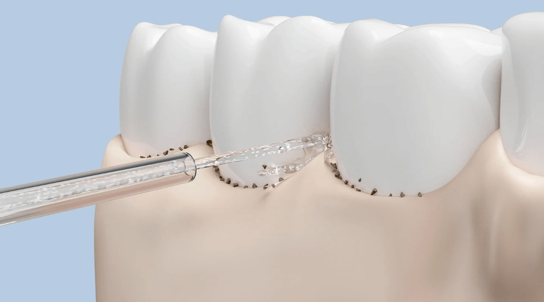 Xiaomi Water Flosser Replacement Tips