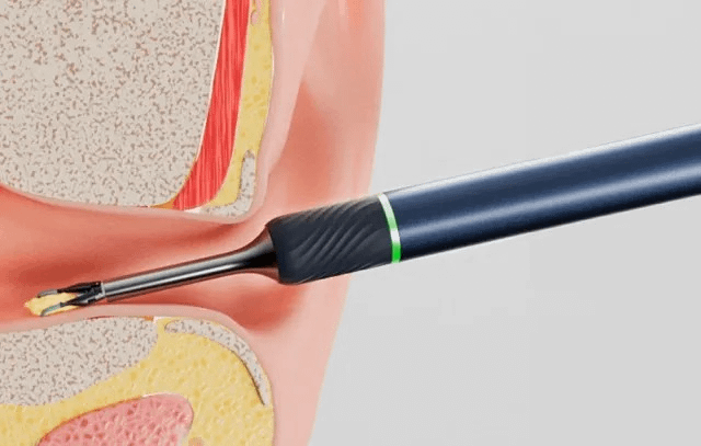 Bebird Note 5 Smart Visual Ear-Clean Rod